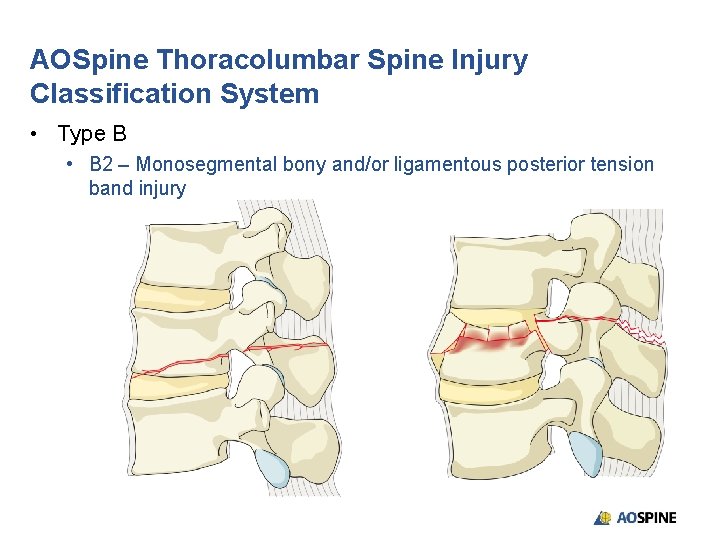 AOSpine Thoracolumbar Spine Injury Classification System • Type B • B 2 – Monosegmental
