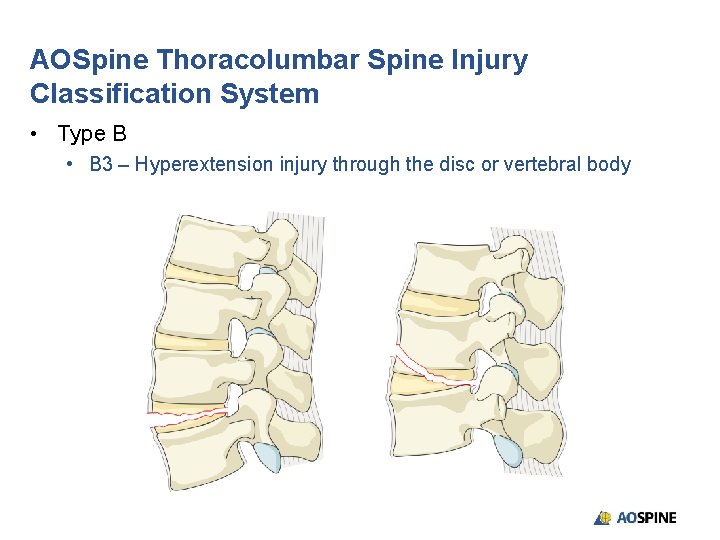 AOSpine Thoracolumbar Spine Injury Classification System • Type B • B 3 – Hyperextension