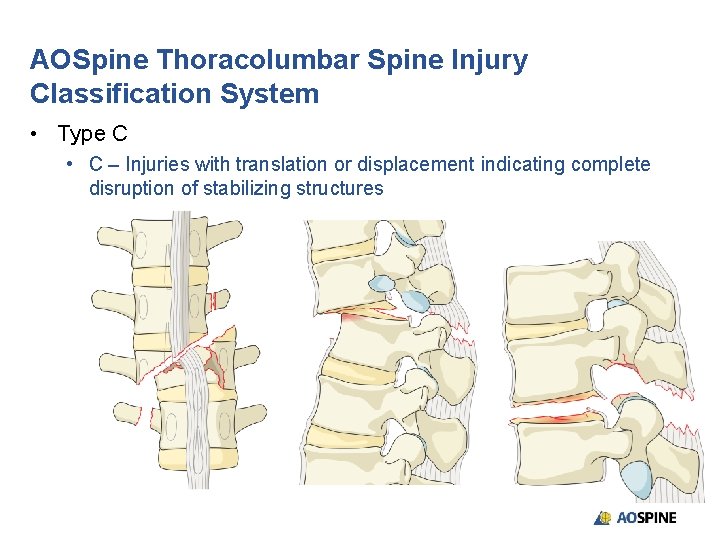 AOSpine Thoracolumbar Spine Injury Classification System • Type C • C – Injuries with