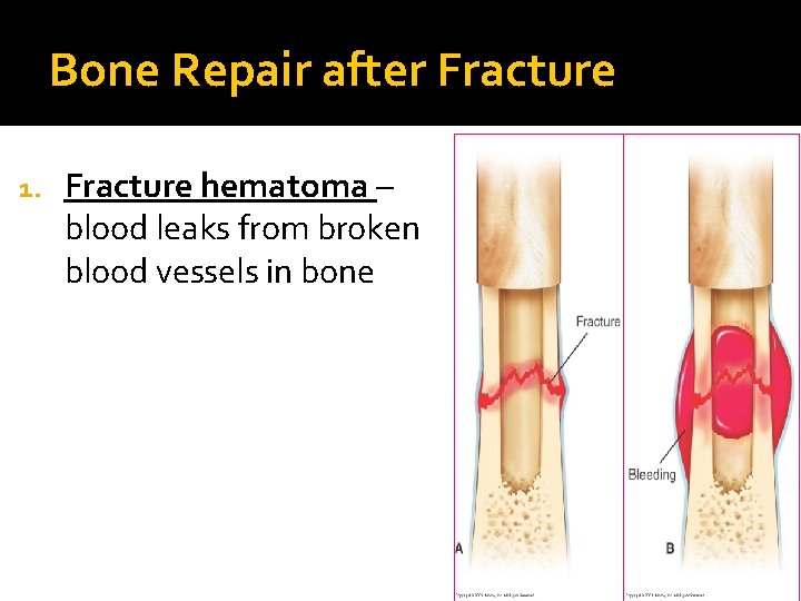 Bone Repair after Fracture 1. Fracture hematoma – blood leaks from broken blood vessels