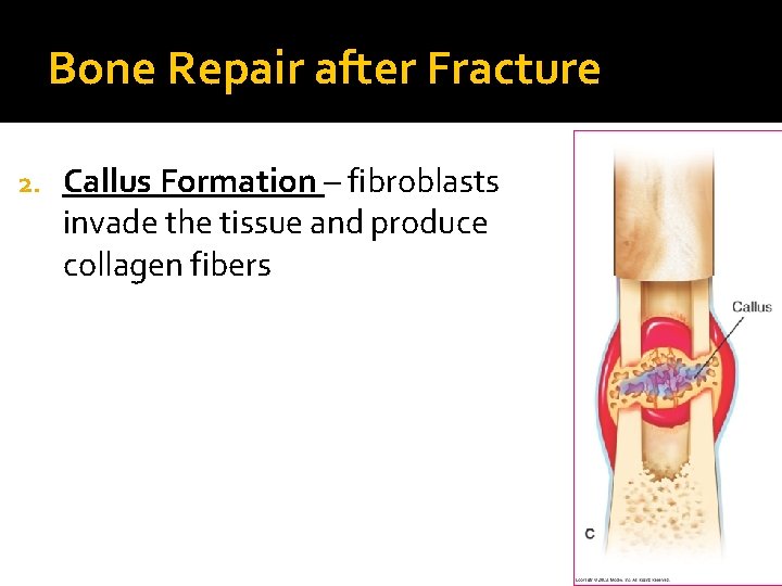Bone Repair after Fracture 2. Callus Formation – fibroblasts invade the tissue and produce