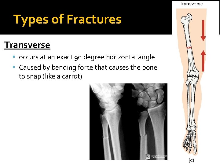 Types of Fractures Transverse occurs at an exact 90 degree horizontal angle Caused by
