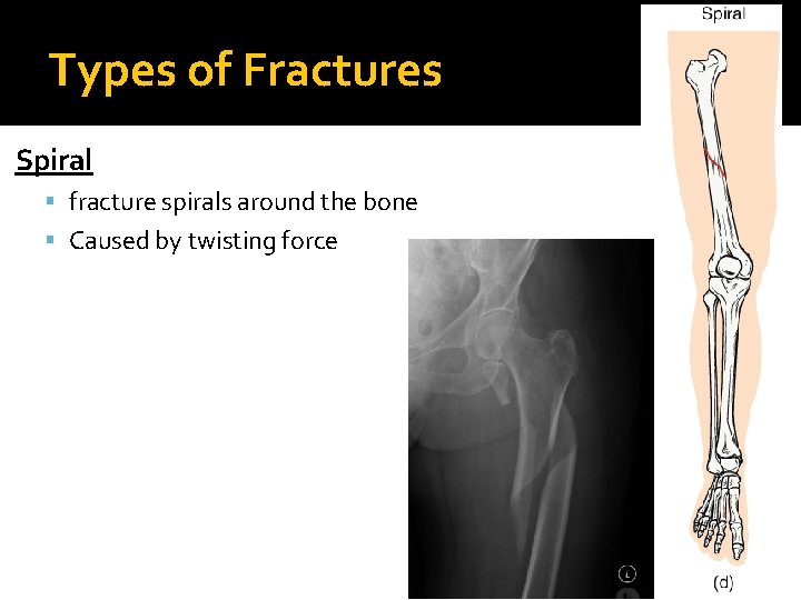 Types of Fractures Spiral fracture spirals around the bone Caused by twisting force 