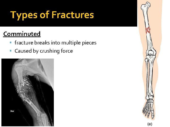 Types of Fractures Comminuted fracture breaks into multiple pieces Caused by crushing force 