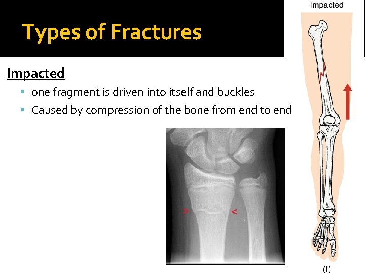Types of Fractures Impacted one fragment is driven into itself and buckles Caused by