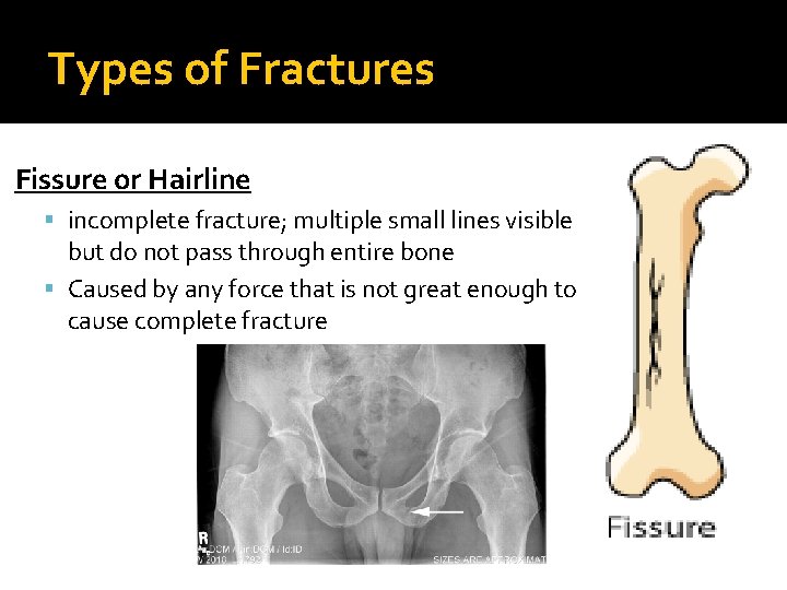 Types of Fractures Fissure or Hairline incomplete fracture; multiple small lines visible but do