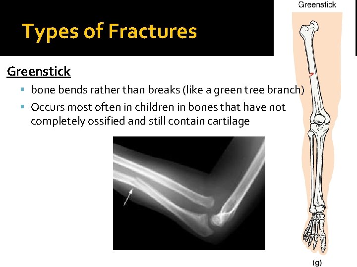 Types of Fractures Greenstick bone bends rather than breaks (like a green tree branch)