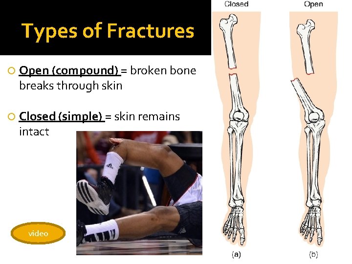 Types of Fractures Open (compound) = broken bone breaks through skin Closed (simple) =