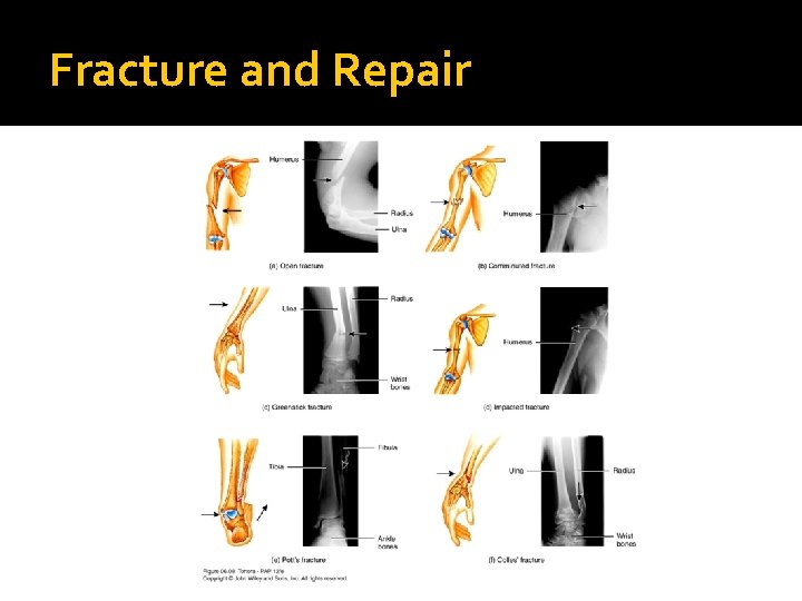 Fracture and Repair 