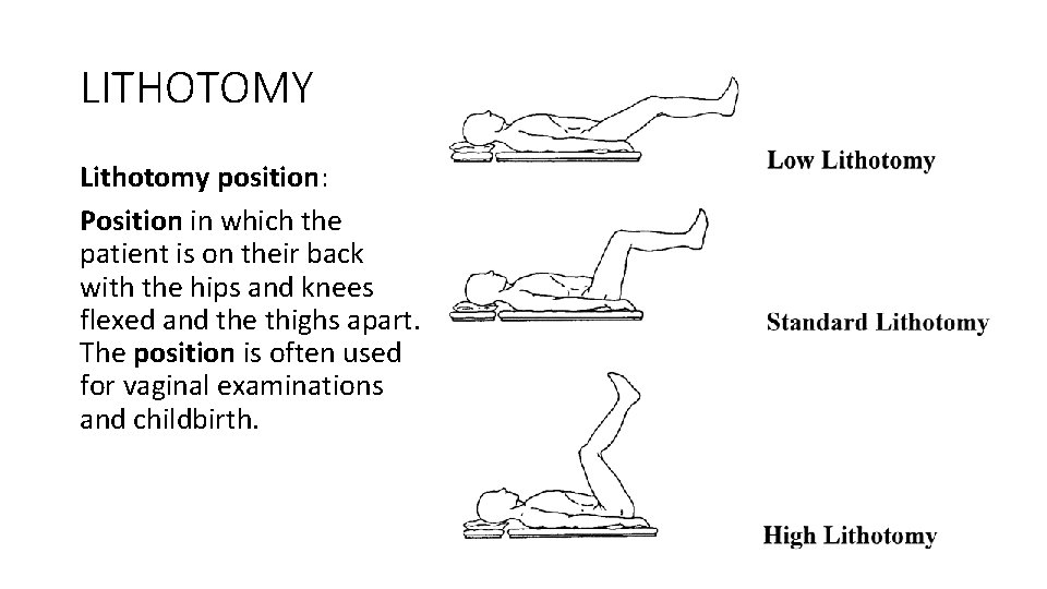 LITHOTOMY Lithotomy position: Position in which the patient is on their back with the