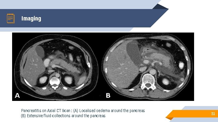 Imaging Pancreatitis on Axial CT Scan : (A) Localised oedema around the pancreas (B)