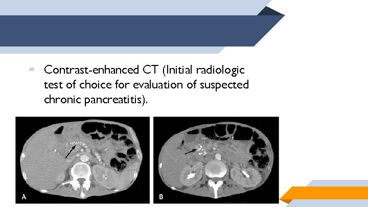 ▰ Contrast-enhanced CT (Initial radiologic test of choice for evaluation of suspected chronic pancreatitis).