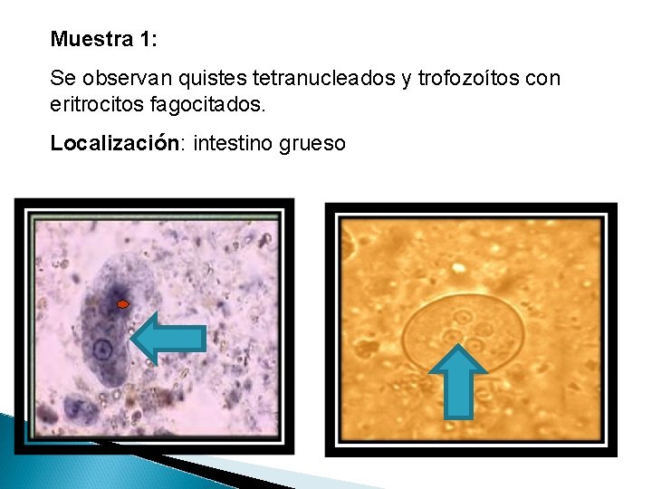Muestra 1: Se observan quistes tetranucleados y trofozoítos con eritrocitos fagocitados. Localización: intestino grueso