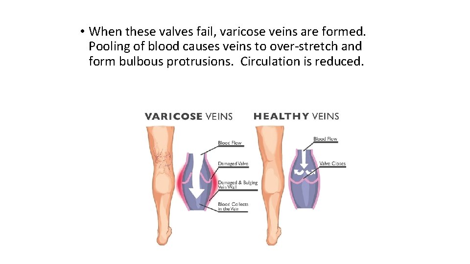  • When these valves fail, varicose veins are formed. Pooling of blood causes