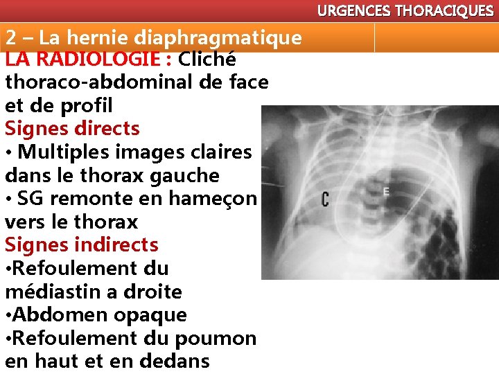 URGENCES THORACIQUES 2 – La hernie diaphragmatique LA RADIOLOGIE : Cliché thoraco-abdominal de face