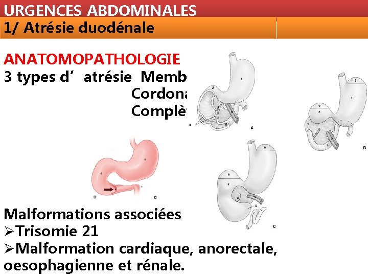 URGENCES ABDOMINALES 1/ Atrésie duodénale ANATOMOPATHOLOGIE 3 types d’atrésie Membraneuse Cordonale Complète Malformations associées