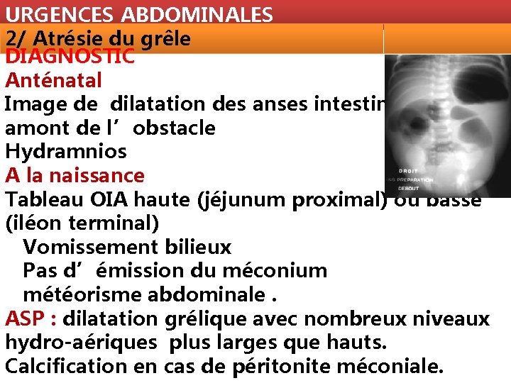URGENCES ABDOMINALES 2/ Atrésie du grêle DIAGNOSTIC Anténatal Image de dilatation des anses intestinales