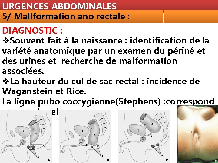 URGENCES ABDOMINALES 5/ Mallformation ano rectale : DIAGNOSTIC : v. Souvent fait à la