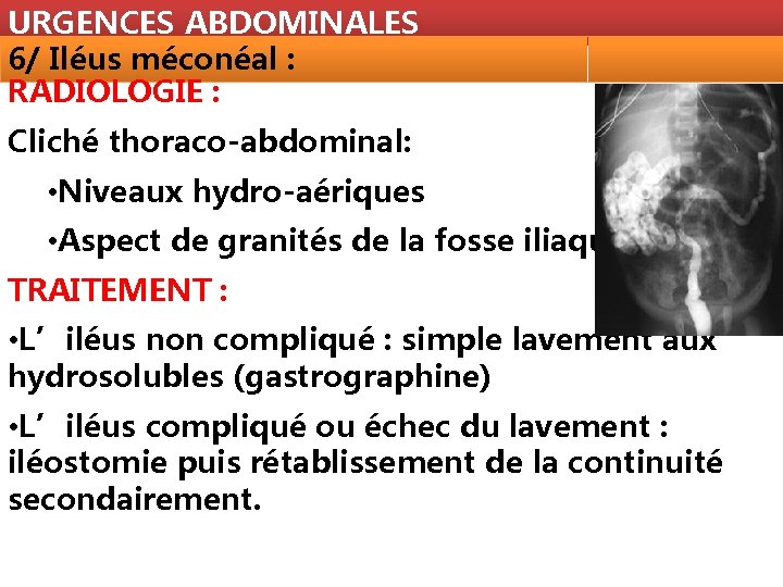 URGENCES ABDOMINALES 6/ Iléus méconéal : RADIOLOGIE : Cliché thoraco-abdominal: • Niveaux hydro-aériques •