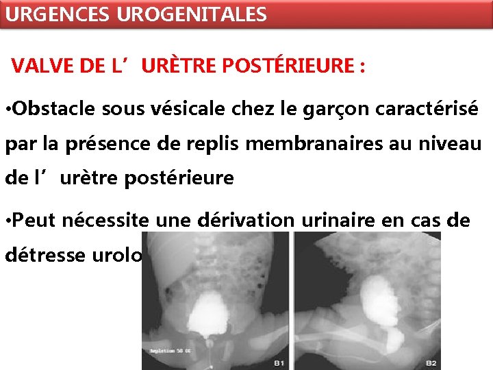 URGENCES UROGENITALES VALVE DE L’URÈTRE POSTÉRIEURE : • Obstacle sous vésicale chez le garçon