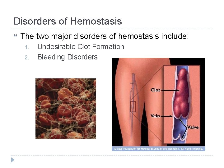 Disorders of Hemostasis The two major disorders of hemostasis include: 1. 2. Undesirable Clot