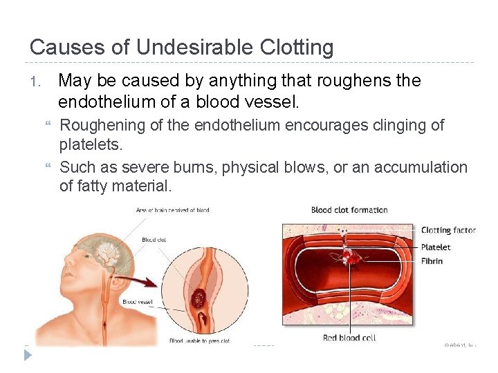 Causes of Undesirable Clotting May be caused by anything that roughens the endothelium of
