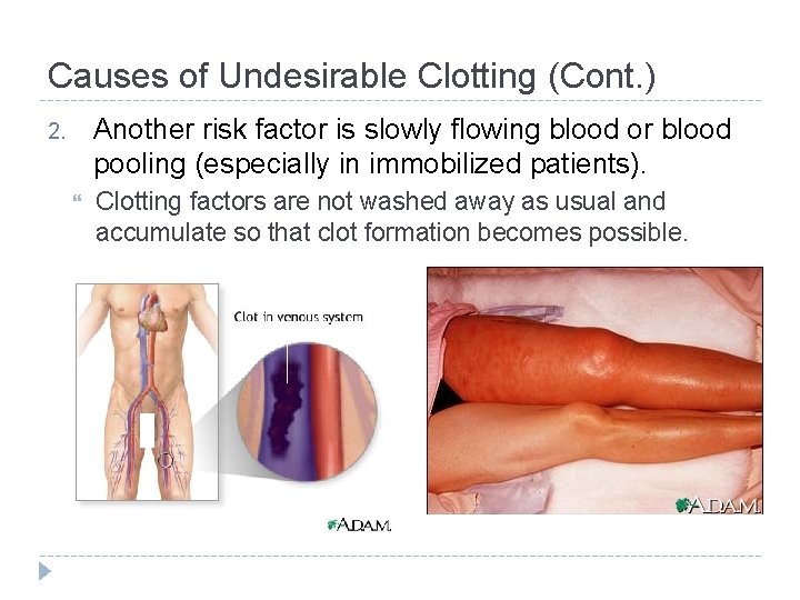 Causes of Undesirable Clotting (Cont. ) Another risk factor is slowly flowing blood or