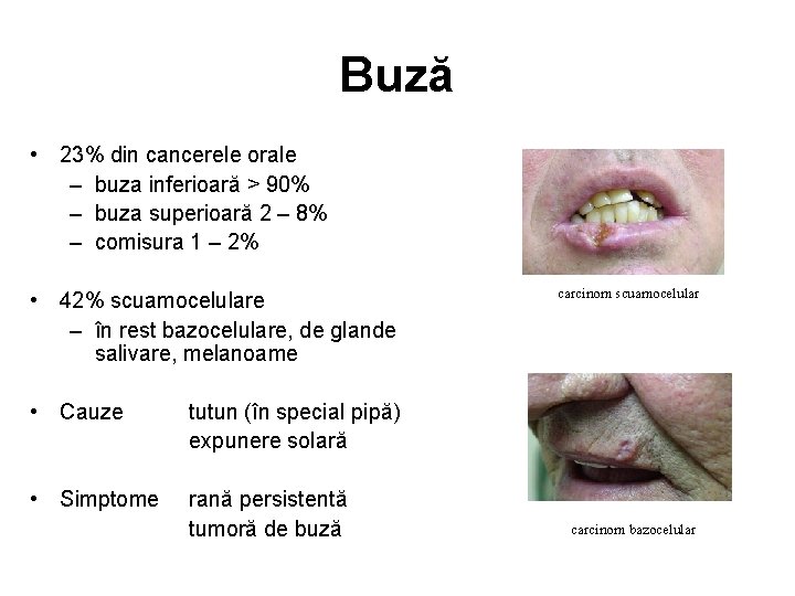 Buză • 23% din cancerele orale – buza inferioară > 90% – buza superioară