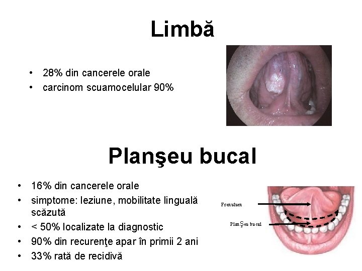 Limbă • 28% din cancerele orale • carcinom scuamocelular 90% Planşeu bucal Frenulum Planşeu