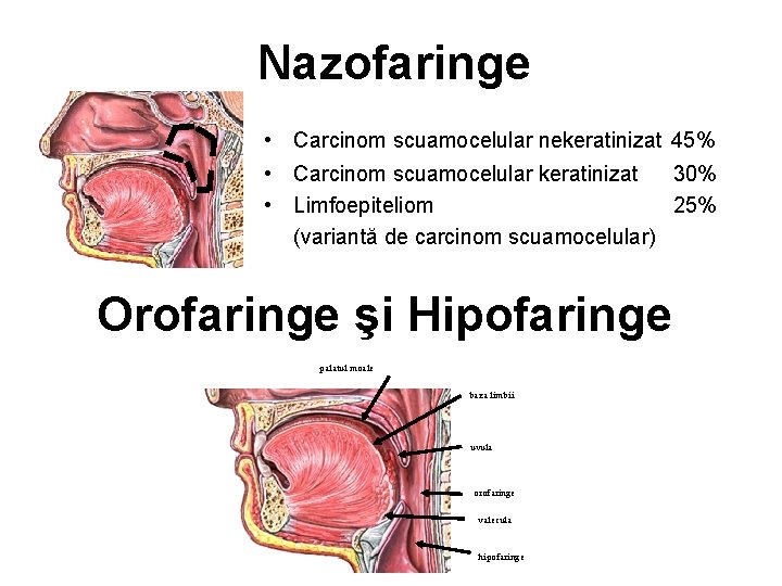 Nazofaringe • Carcinom scuamocelular nekeratinizat 45% • Carcinom scuamocelular keratinizat 30% • Limfoepiteliom 25%