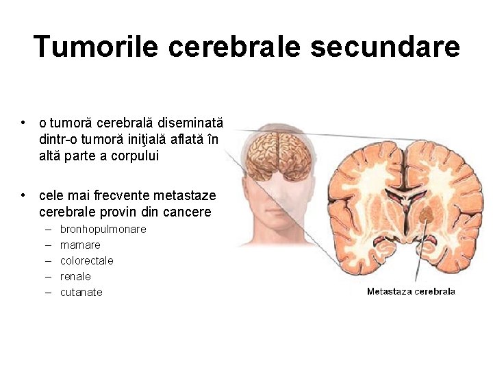 Tumorile cerebrale secundare • o tumoră cerebrală diseminată dintr-o tumoră iniţială aflată în altă