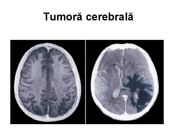 Tumoră cerebrală 