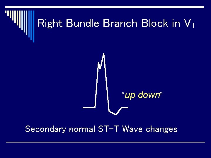 Right Bundle Branch Block in V 1 “up down” Secondary normal ST-T Wave changes
