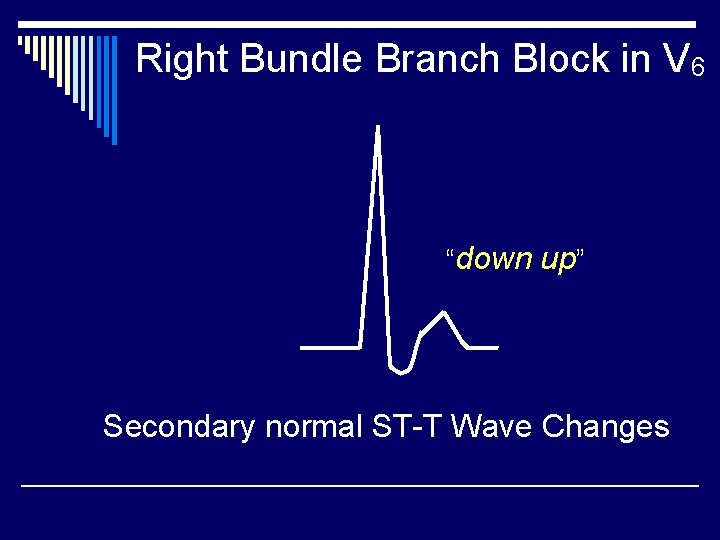Right Bundle Branch Block in V 6 “down up” Secondary normal ST-T Wave Changes