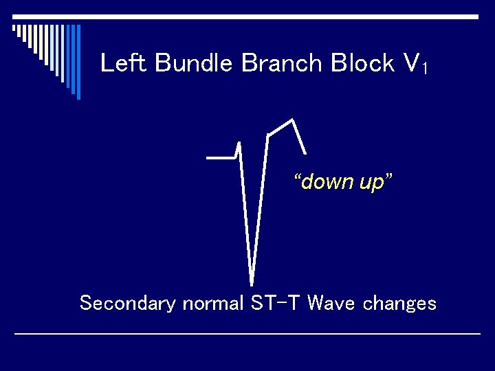 Left Bundle Branch Block V 1 “down up” Secondary normal ST-T Wave changes 