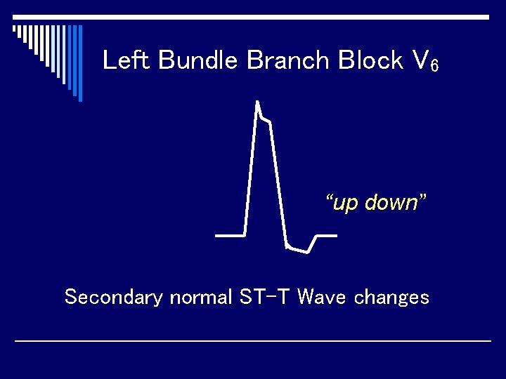 Left Bundle Branch Block V 6 “up down” Secondary normal ST-T Wave changes 