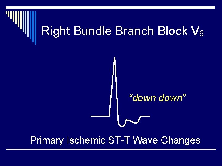 Right Bundle Branch Block V 6 “down” Primary Ischemic ST-T Wave Changes 