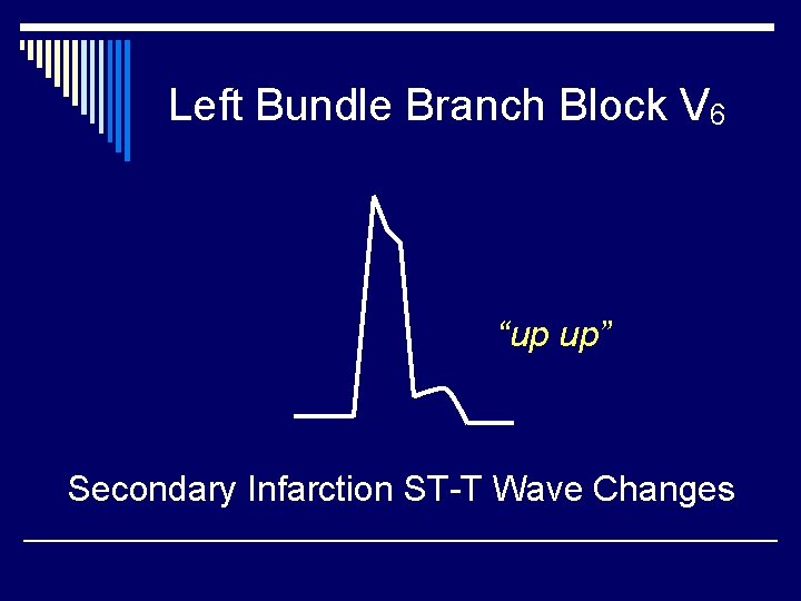 Left Bundle Branch Block V 6 “up up” Secondary Infarction ST-T Wave Changes 