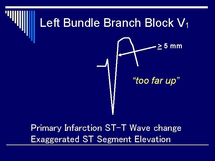 Left Bundle Branch Block V 1 > 5 mm “too far up” Primary Infarction