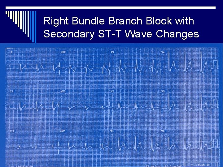 Right Bundle Branch Block with Secondary ST-T Wave Changes 