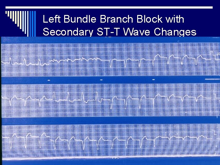 Left Bundle Branch Block with Secondary ST-T Wave Changes 
