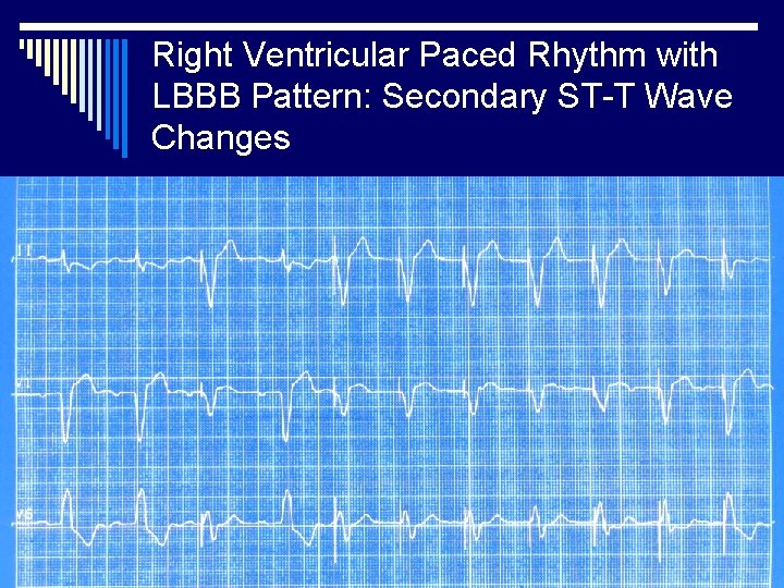 Right Ventricular Paced Rhythm with LBBB Pattern: Secondary ST-T Wave Changes 