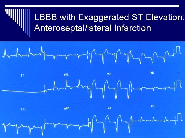 LBBB with Exaggerated ST Elevation: Anteroseptal/lateral Infarction 