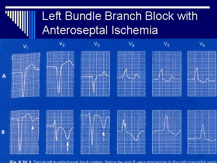 Left Bundle Branch Block with Anteroseptal Ischemia 
