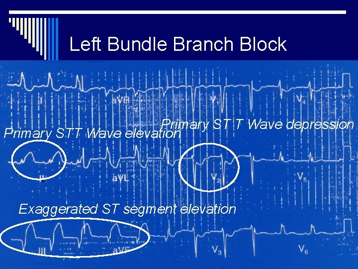 Left Bundle Branch Block Primary ST T Wave depression Primary STT Wave elevation Exaggerated