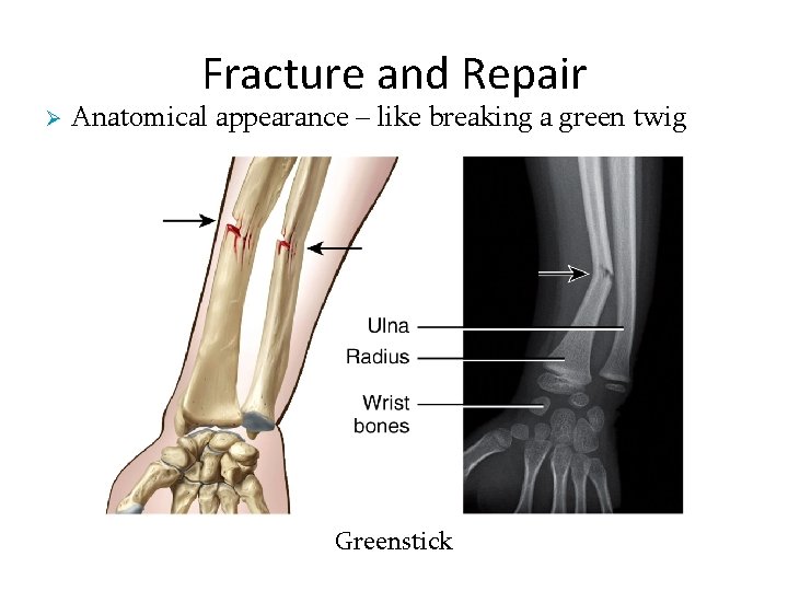 Fracture and Repair Ø Anatomical appearance – like breaking a green twig Greenstick 