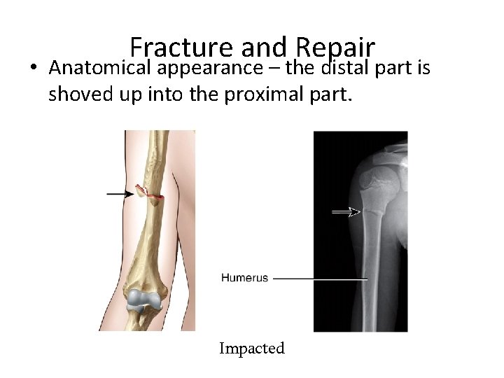 Fracture and Repair • Anatomical appearance – the distal part is shoved up into