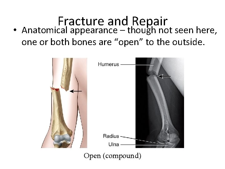 Fracture and Repair • Anatomical appearance – though not seen here, one or both