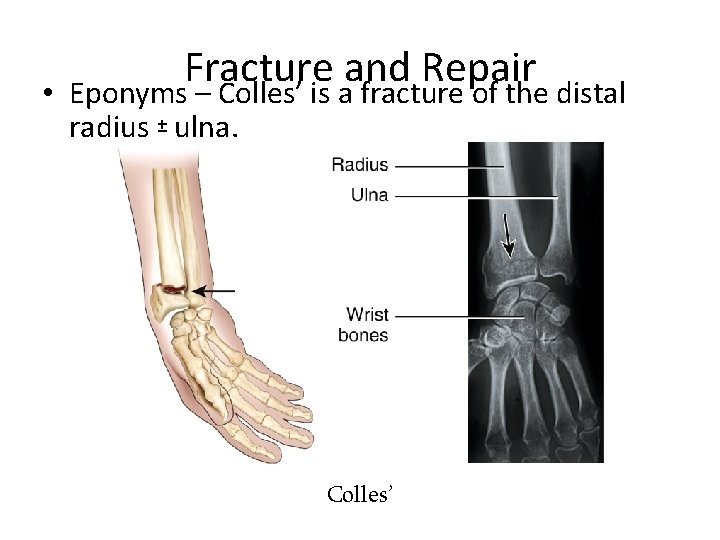  • Fracture and Repair Eponyms – Colles’ is a fracture of the distal
