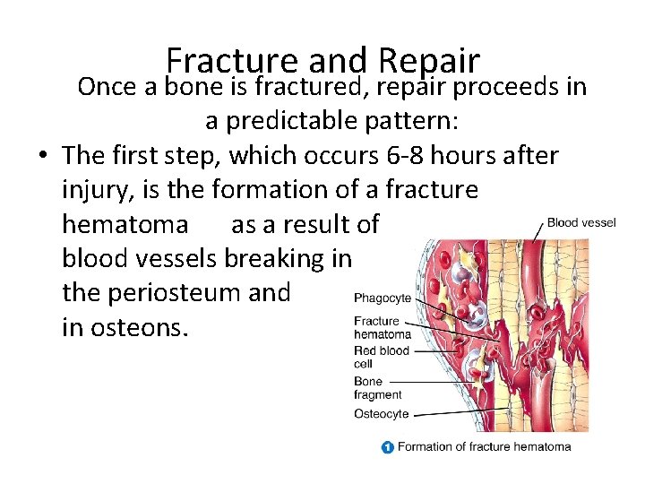 Fracture and Repair Once a bone is fractured, repair proceeds in a predictable pattern: